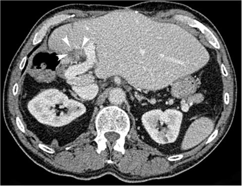 肝門附近的轉移瘤的不可逆電穿孔