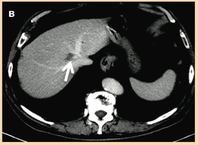 病例報告：肝轉移瘤的不可逆電穿孔